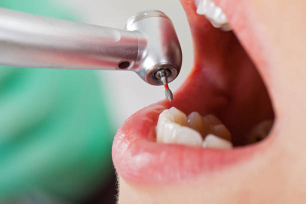 Best Emergency Tooth Extraction in New Baden, IL